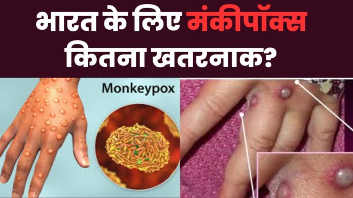 Monkeypox Case