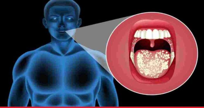 Mouth Cancer Causes